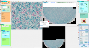Cervical Cancer Positive Cell Slice Scanning, Stitching&Identification