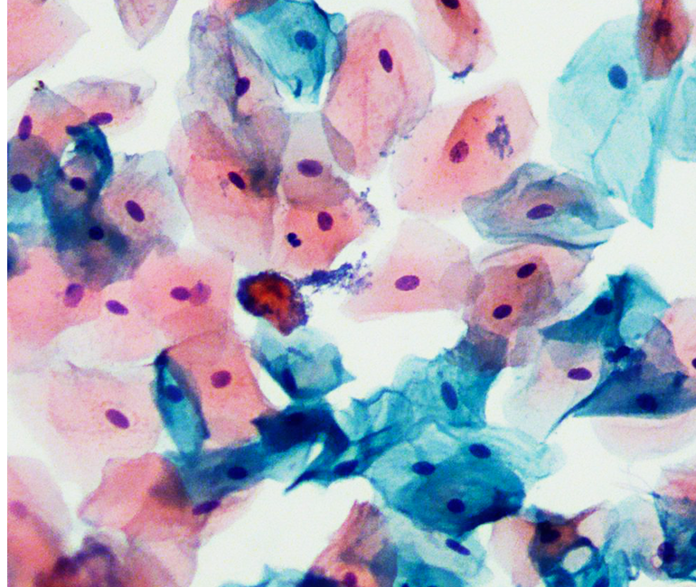 Cervical Cancer Positive Cell Slice Scanning, Stitching&Identification