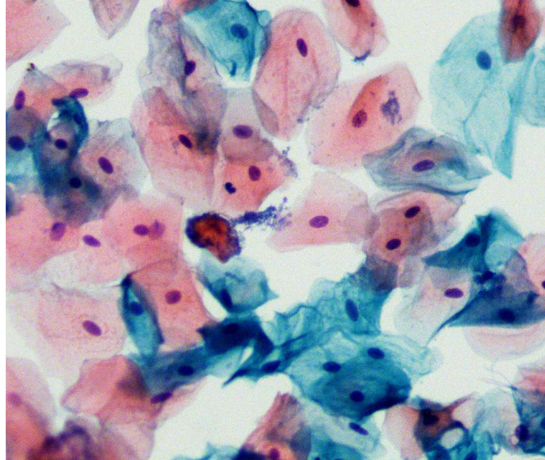 Cervical Cancer Positive Cell Slice Scanning, Stitching&Identification